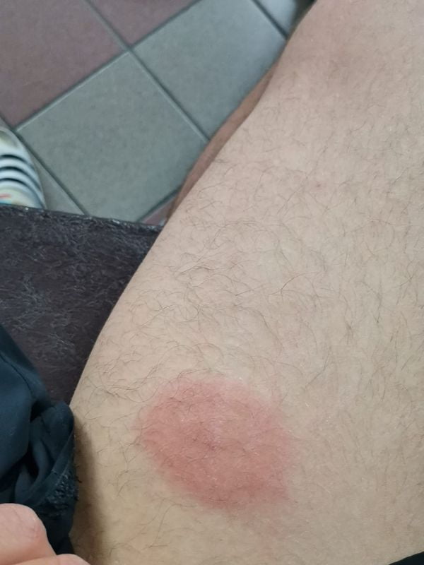 Erythème migrant - maladie de Lyme